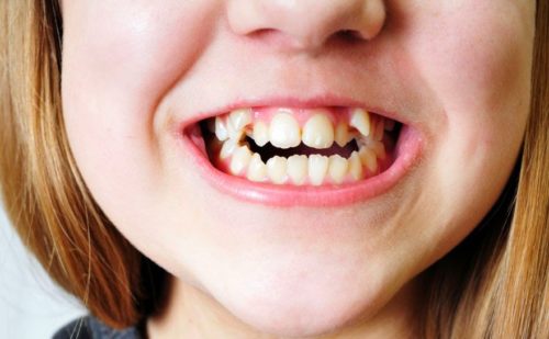 Mơ thấy răng - Chiêm bao thấy răng đánh con gì?